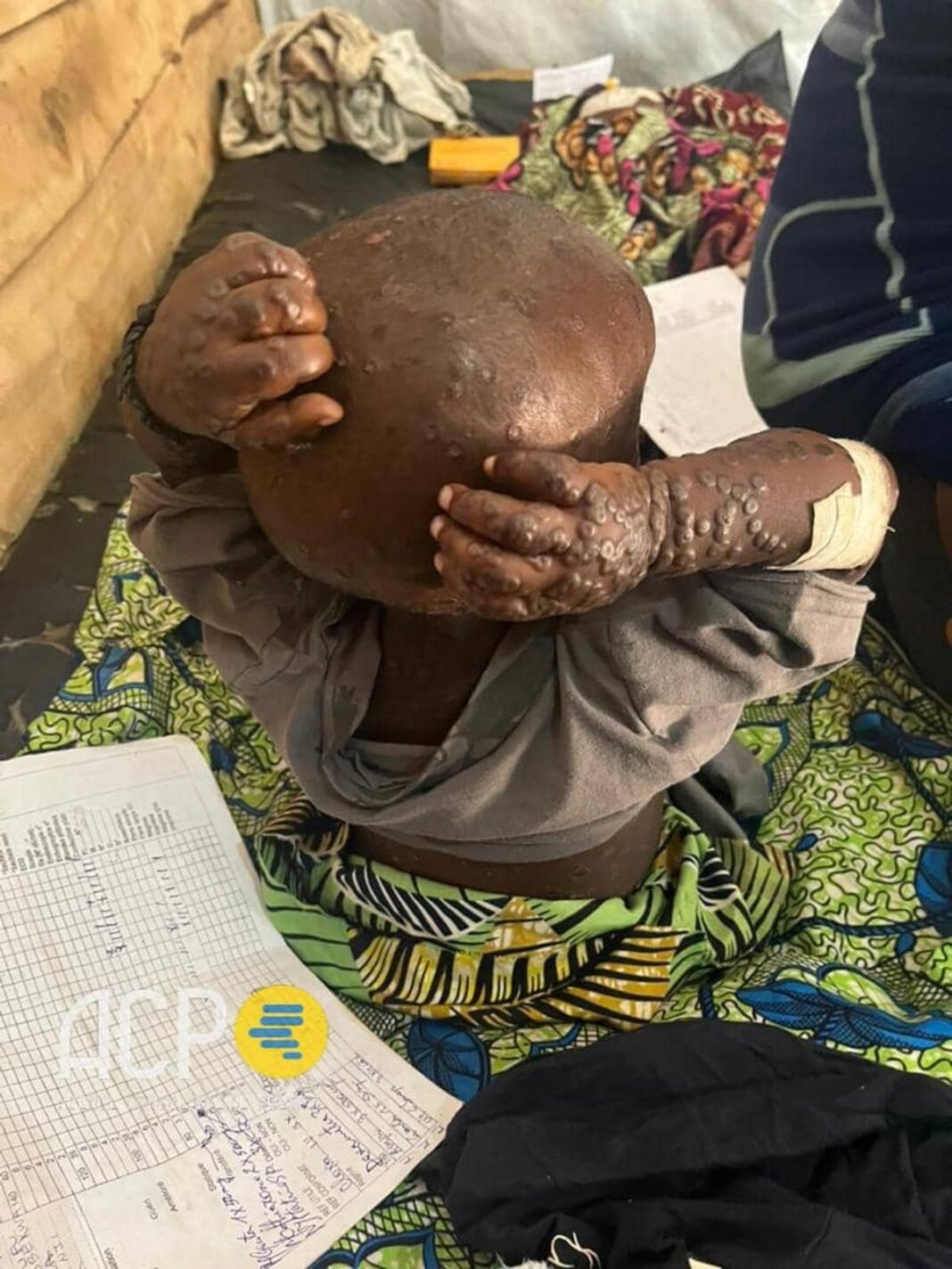 Epidémies en RDC : baisse des cas de M-POX et de choléra