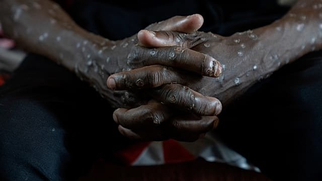 Congo declares end of two-year mpox outbreak that killed over 2,000