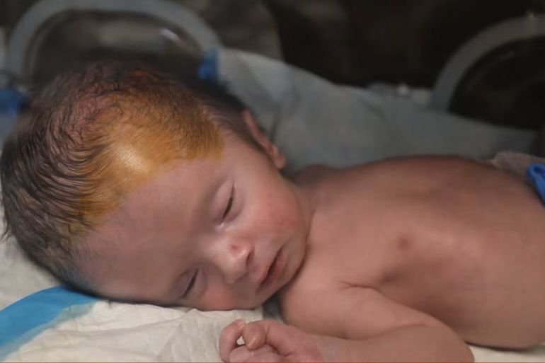 Gaza’s unseen casualties: A surge in stillbirths and birth defects